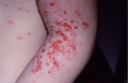 Impetigo